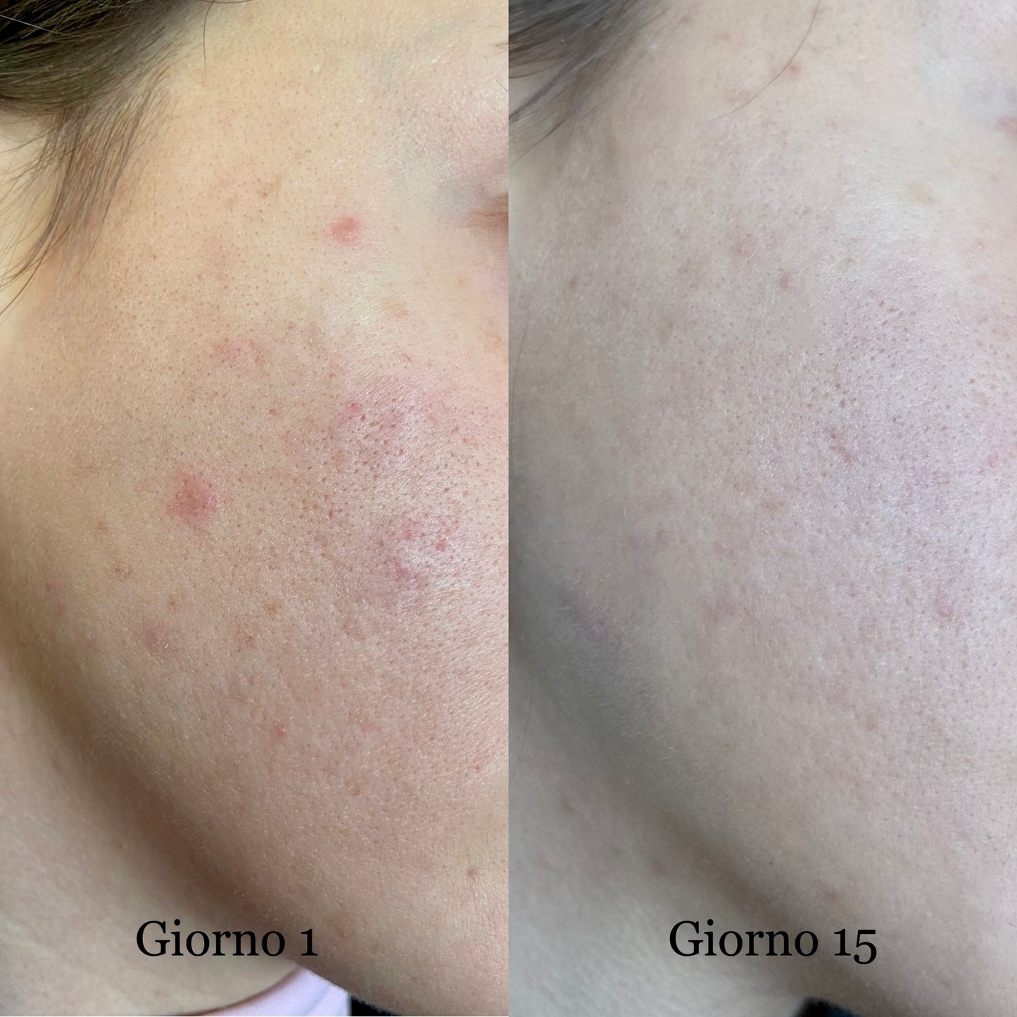 Niacinamide + Zinco - Siero Viso Seboequilibrante e Anti-imperfezioni